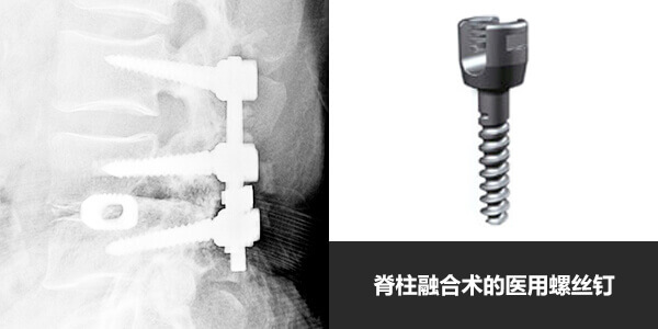 脊柱融合术使用的螺丝钉