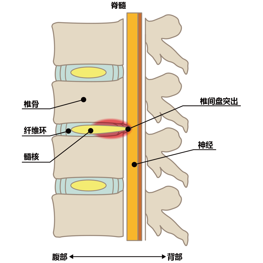 椎间盘退行性病变（側面図）