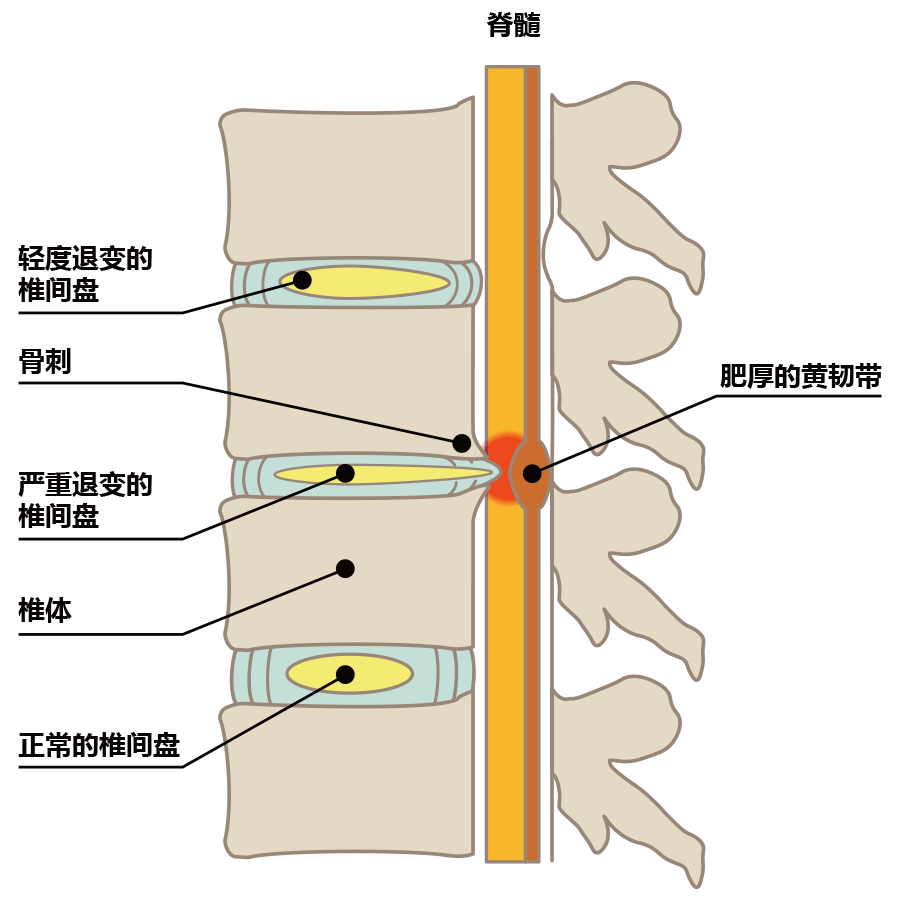 腰椎管狭窄