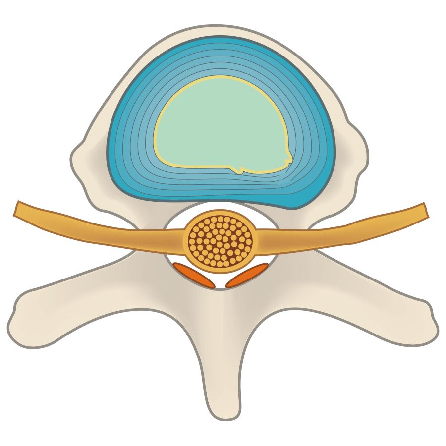 突出来的椎间盘通过减压回缩，治疗后凝胶会成为椎间盘一部分，起到缓冲作用。