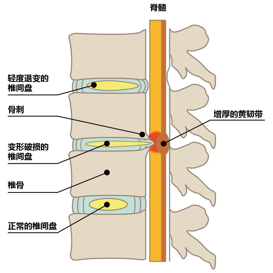 椎间盘几乎消失，椎骨变形，导致神经被压迫，如图（側面図）