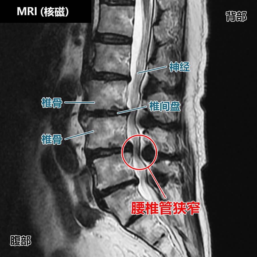 腰椎管狭窄-MRI