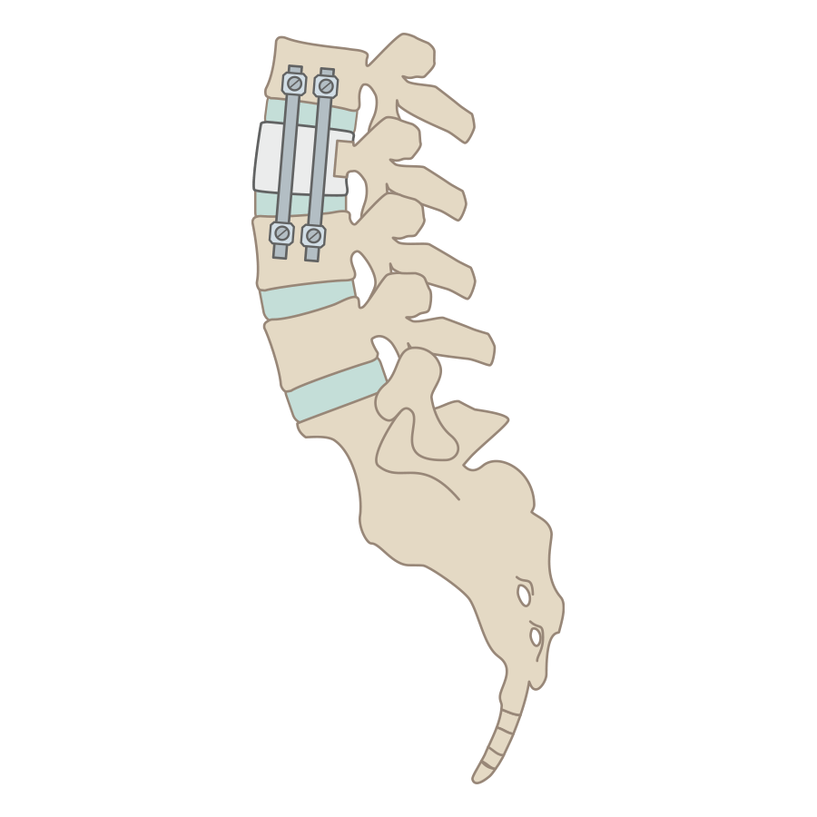 前路腰椎椎间融合术