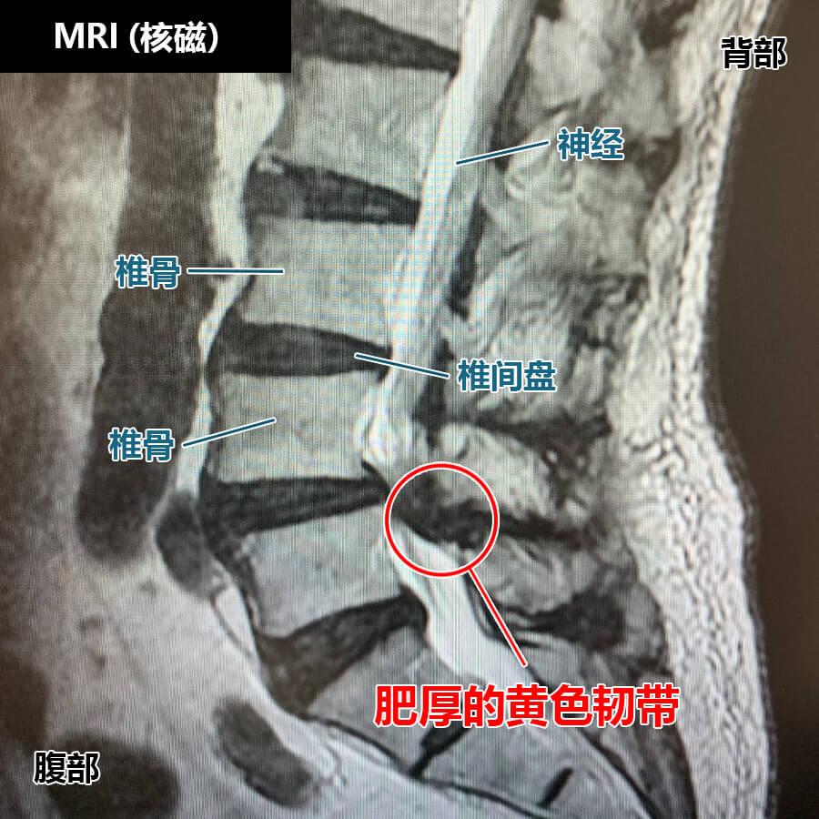 腰椎滑脱症的诊断方法：MRI
