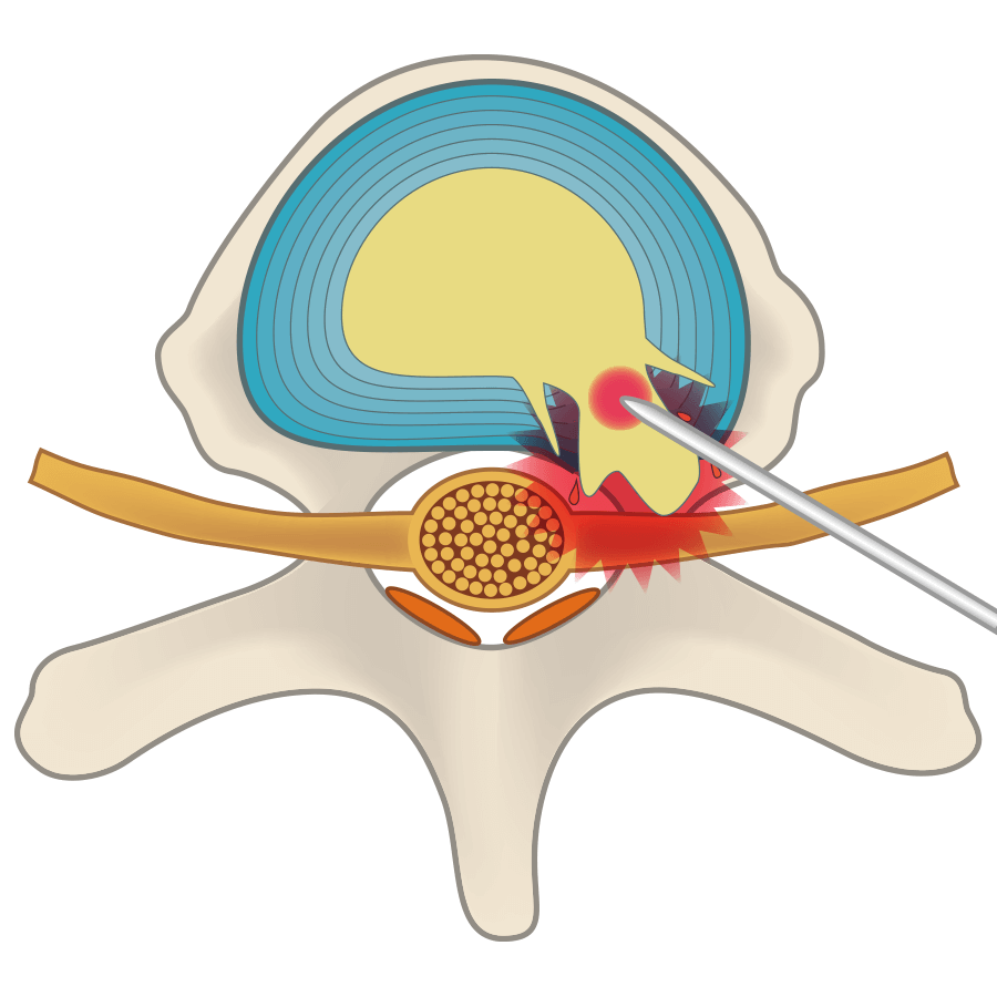 通过激光的热量使椎间盘中的一部分髓核蒸发，出现空洞，使突出的椎间盘缩回。