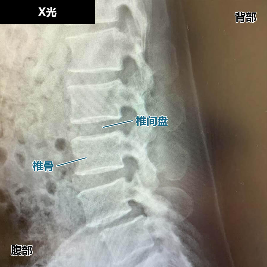 腰椎滑脱症的诊断方法：X光