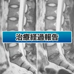 治疗后3年又出现腰痛